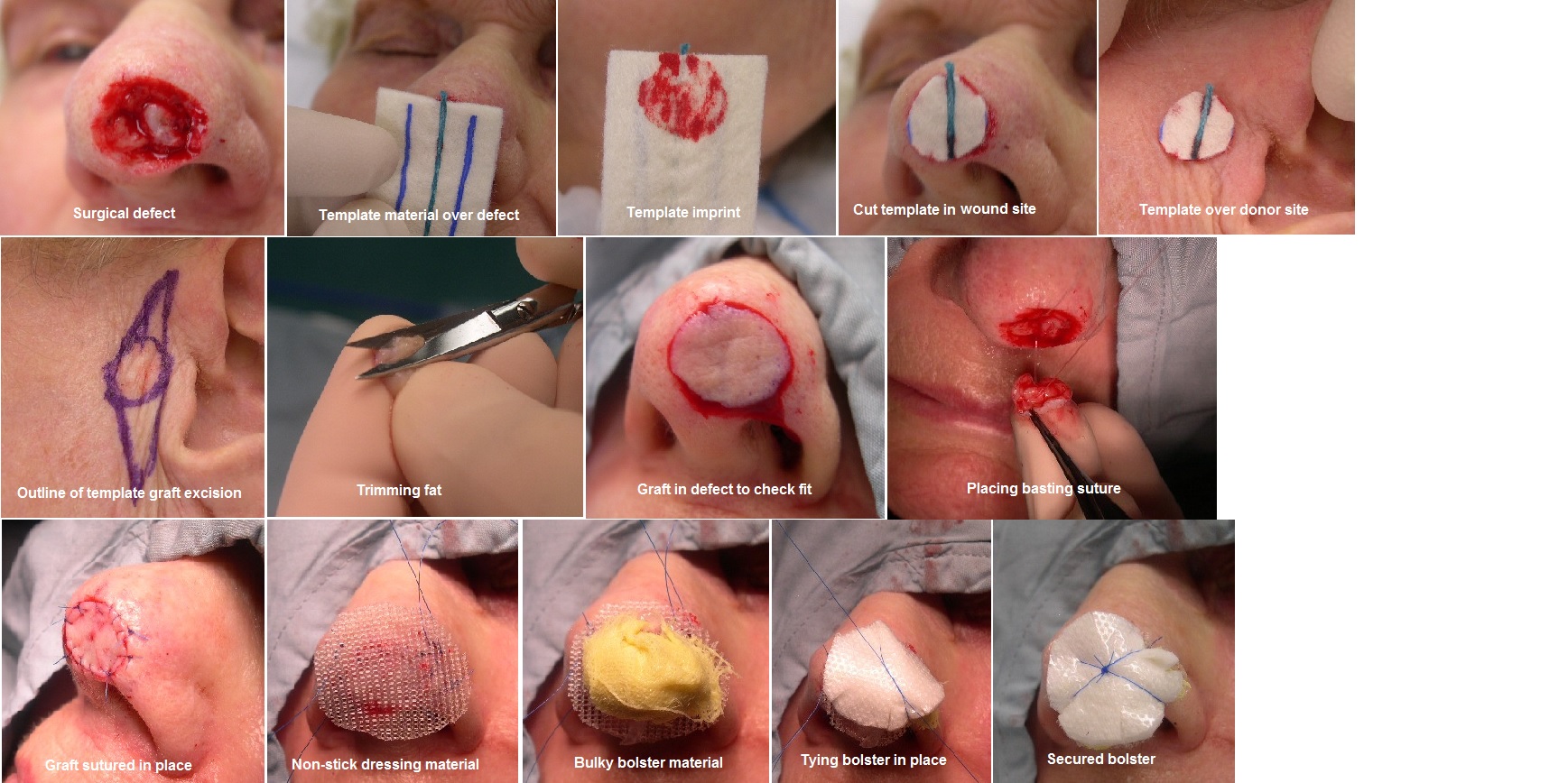 <p>Full-Thickness Skin Graft Procedure