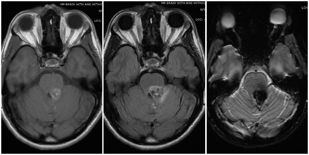<p>Cavernoma, Zabramski Classification