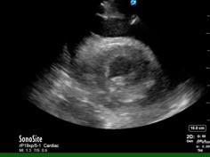Pericardial Effusion