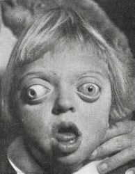 <p>Crouzon Syndrome in a Patient Exhibiting Craniofacial Deformities
