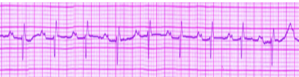 <p><strong>ECG&nbsp;Left Atrial Enlargement.</strong> An ECG tracing indicative of left atrial enlargement.</p>