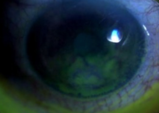 <p>Stage 1 Neurotrophic Keratitis