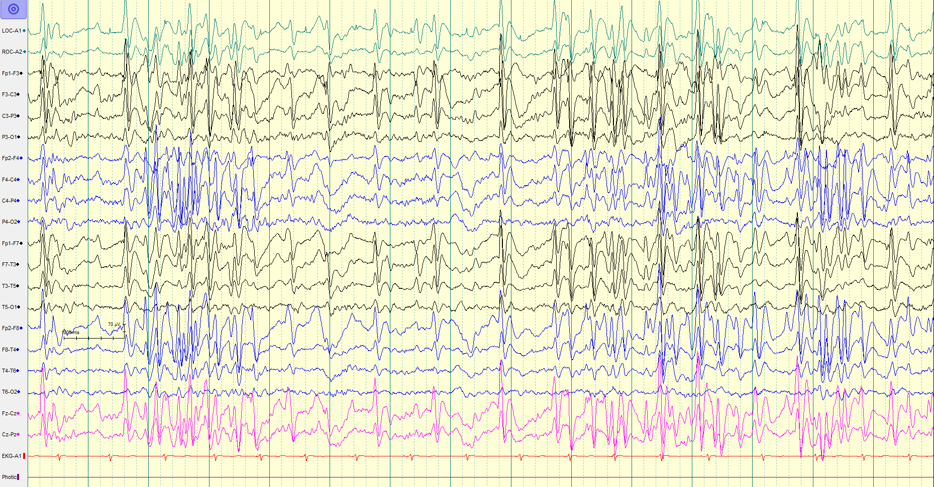 <p>Electroencephalogram in Lennox-Gastaut Syndrome