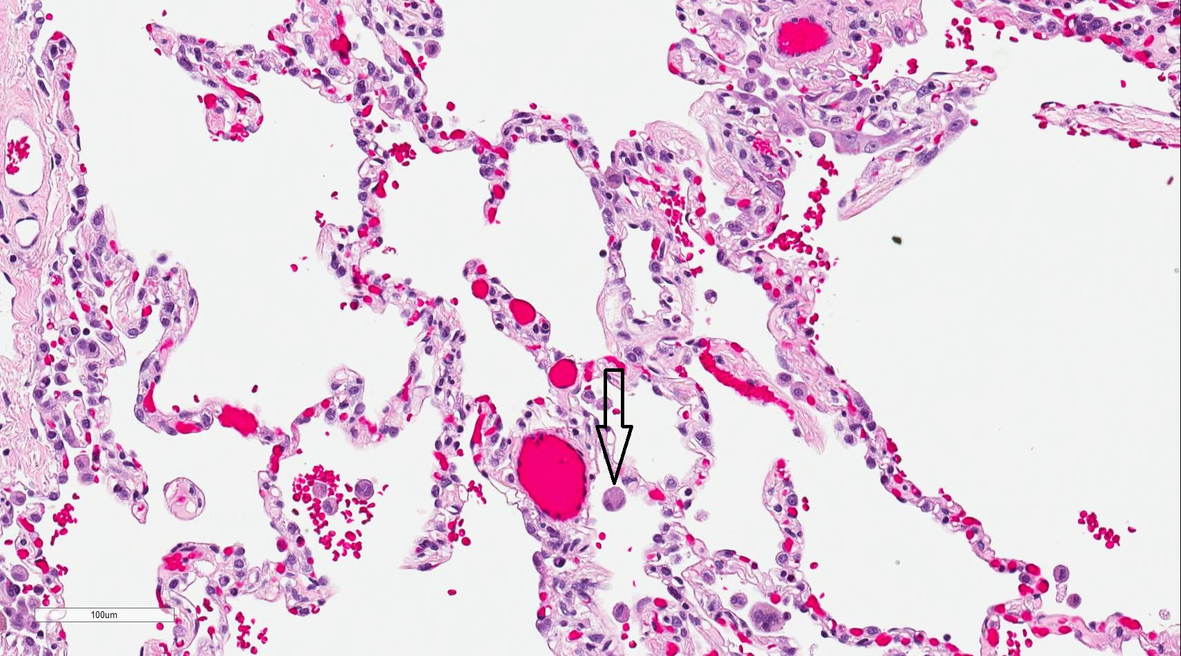 <p>Alveolar Macrophage