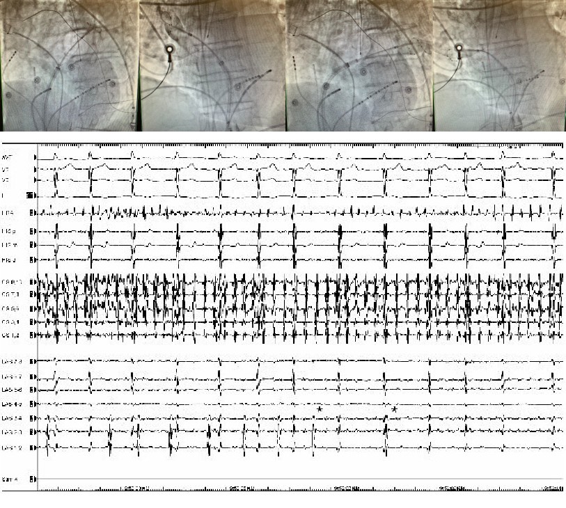 Pulmonary Vein Radiographs and EKG