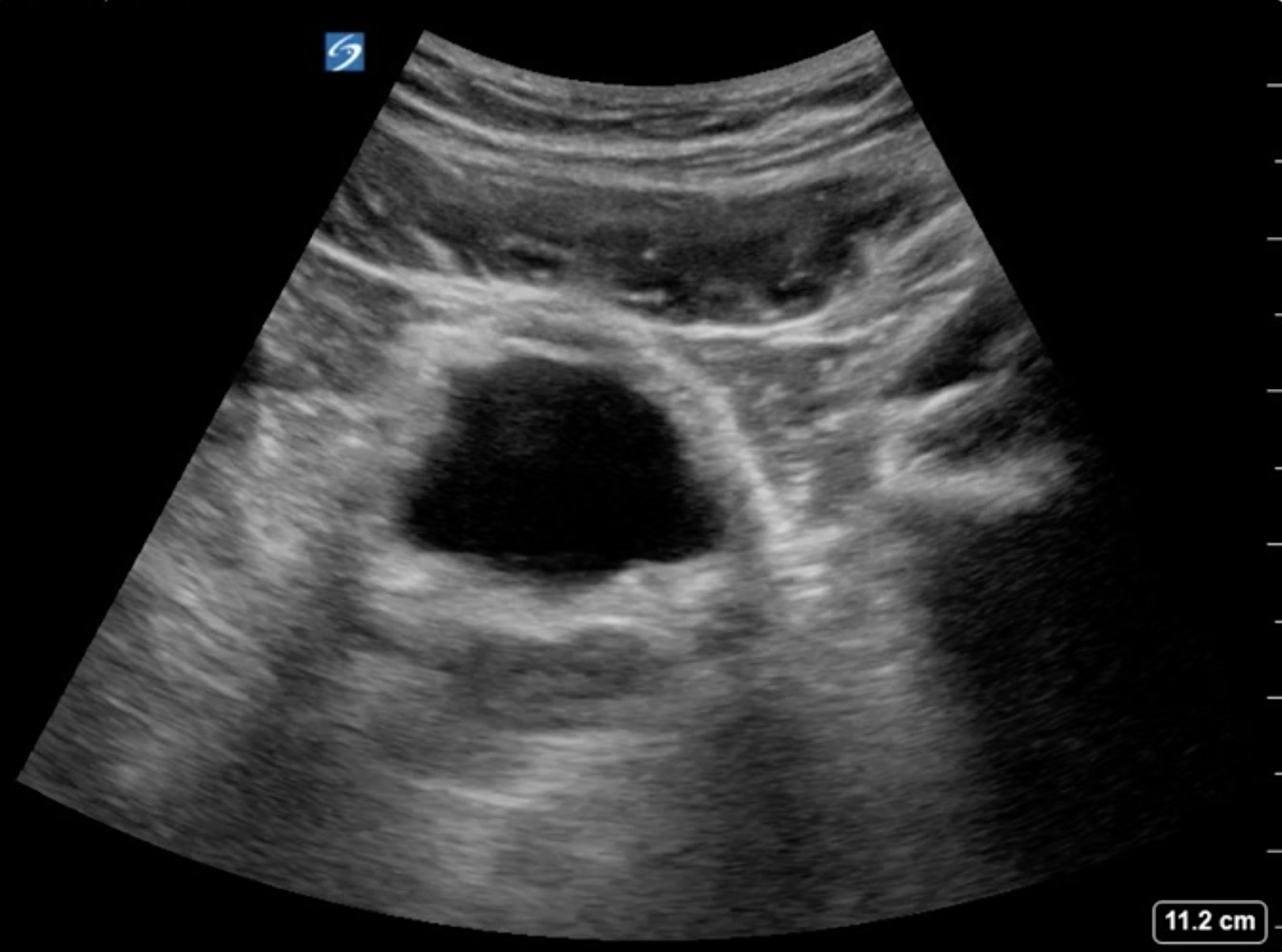 Ultrasound of bladder in transverse view