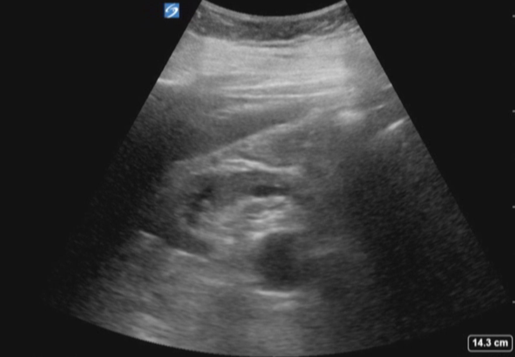 Extrarenal pelvis on ultrasound