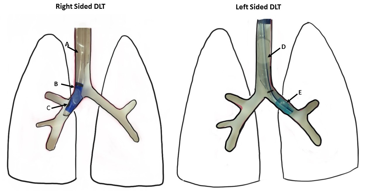 <p>Optimal Position of Right- and Left-Sided Double Lumen Tubes