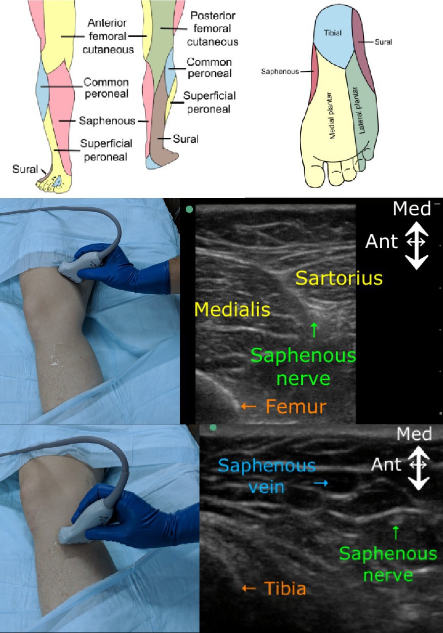 <p>Saphenous Nerve Block. Image of saphenous nerve block.</p>