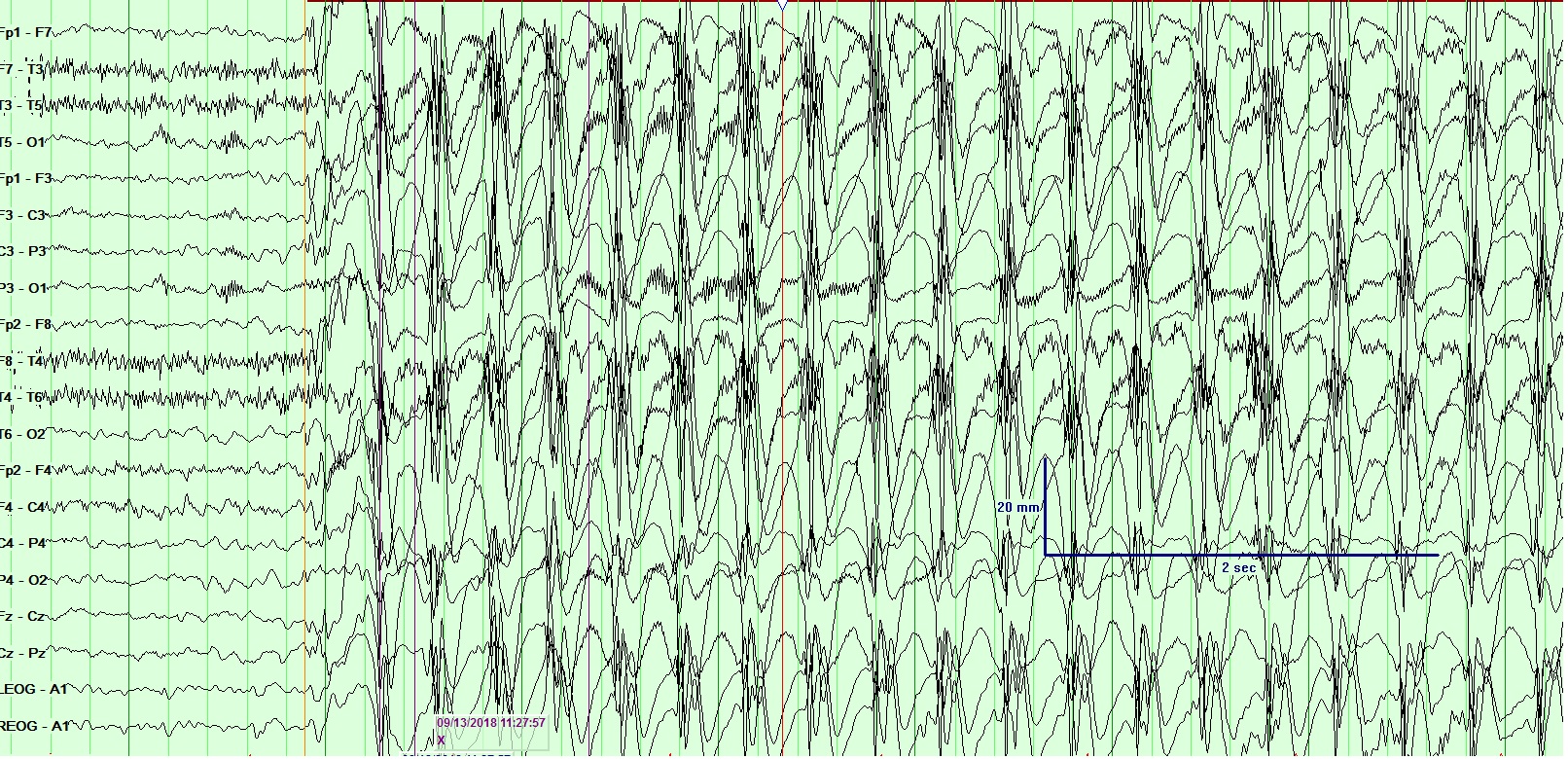 <p>Electroencephalogram (EEG), General Epileptiform. This EEG shows the characteristics of a general epileptic seizure.</p>