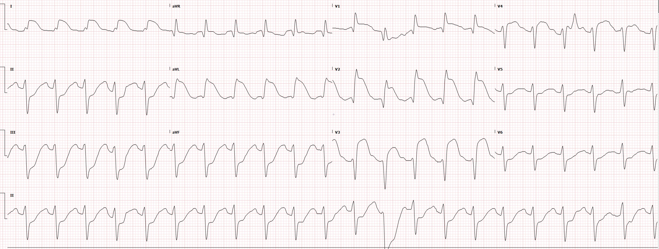 <p>Electrocardiogram Tracing for a Case of Proximal Left Anterior Descending Occlusion