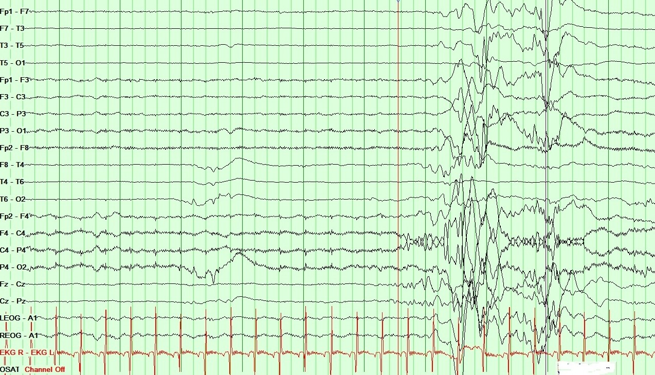 Neonatal EEG showing Burst Suppression pattern in Ohtahara syndrome