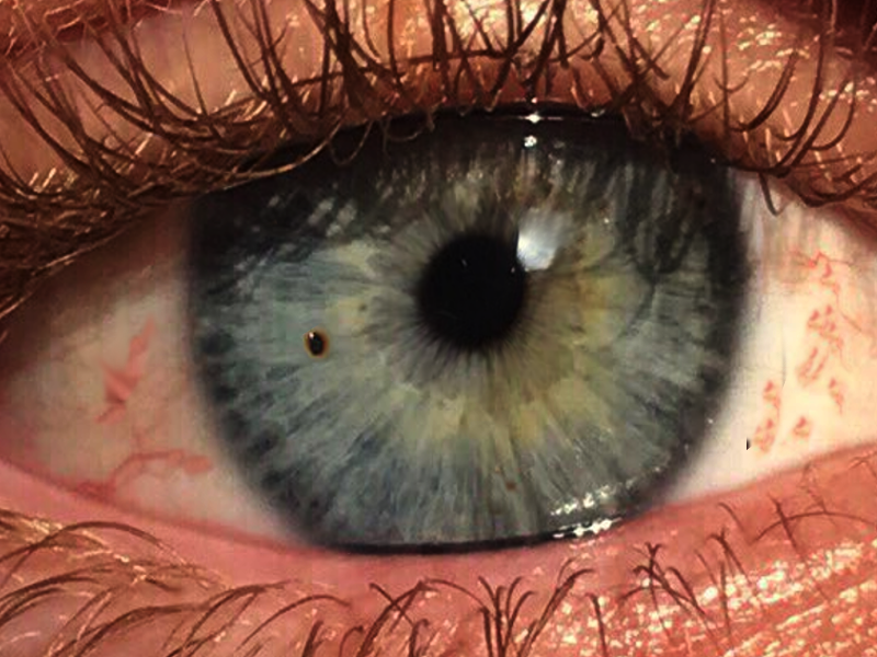<p>Corneal Foreign Body.</p>
