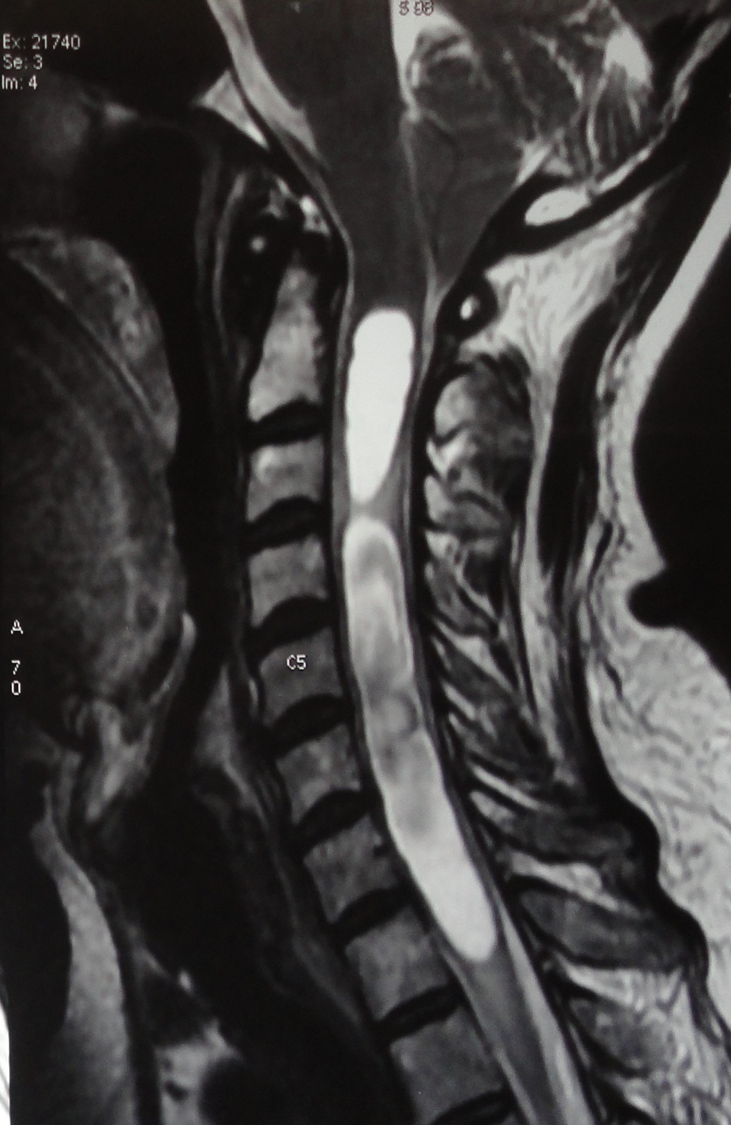 <p>Syringomyelia on Magnetic Resonance Imaging. This syringomelia is seen in a patient with hindbrain herniation.</p>