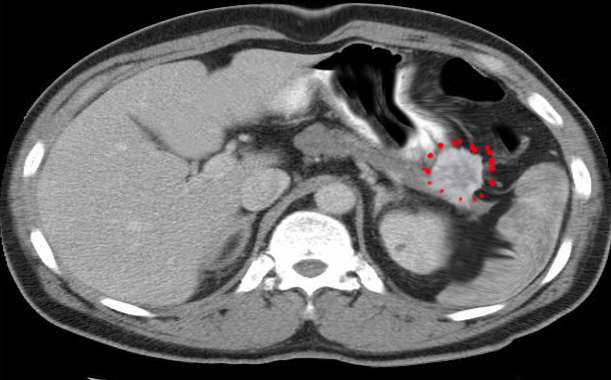 <p>Gastrinoma on Distal Pancreas</p>