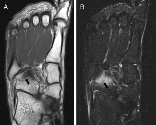 <p>MRI image of increased signal (white areas) on the cuboid bone which indicates a stress fracture</p>