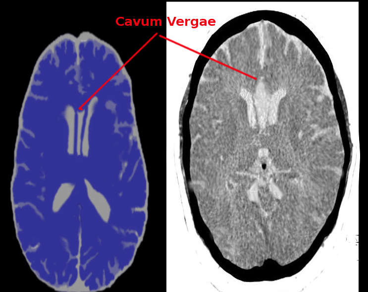 <p>Cavum Septum Pellucidum</p>