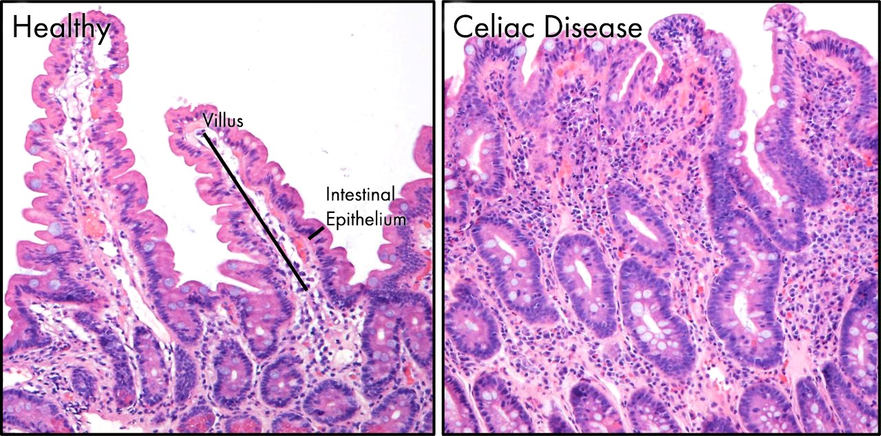 <p>Intestinal Changes in Celiac Disease