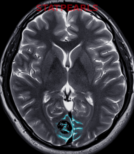 <p>Cerebral Cavernous Hemangioma