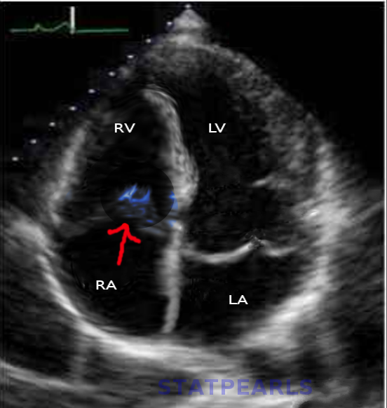 <p>Tricuspid Valve Endocarditis on Cardiac Ultrasound. The red arrow points to a vegetation on the tricuspid valve.</p>