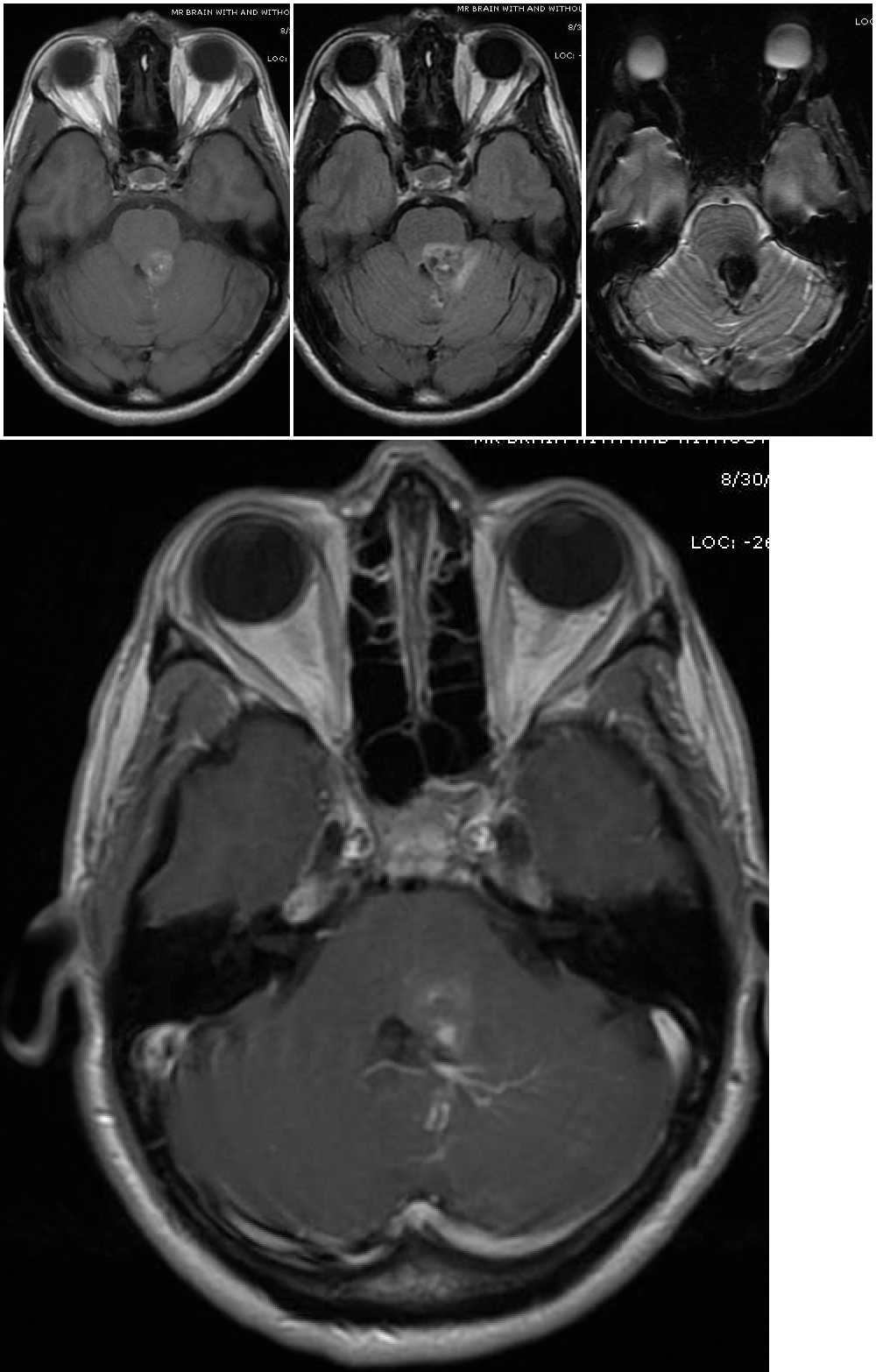 <p>Cavernous Malformation
