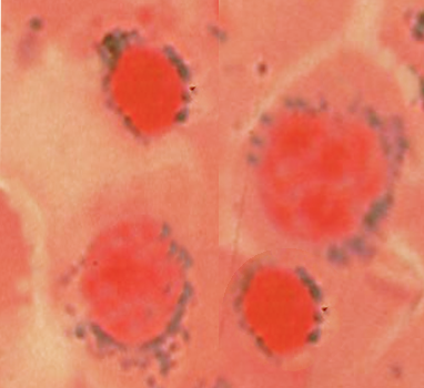 <p>Sideroblastic Anemia