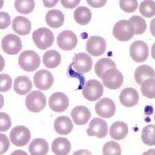 <p>Chagas Disease
