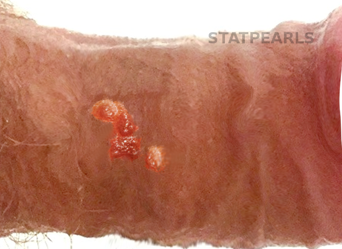 <p>Bowenoid Papulosis.&nbsp;Bowenoid papulosis is an uncommon sexually transmitted condition.</p>