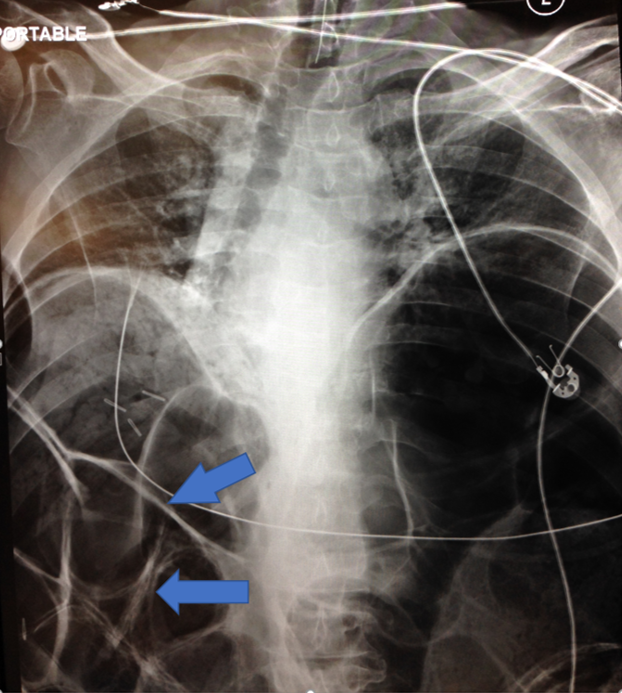 <p>Rigler Sign