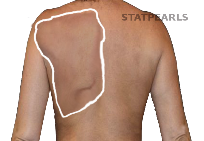 <p>Winging of the Scapula