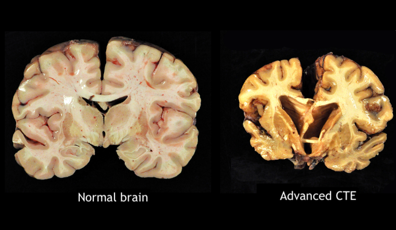 <p>Chronic Traumatic Encephalopathy