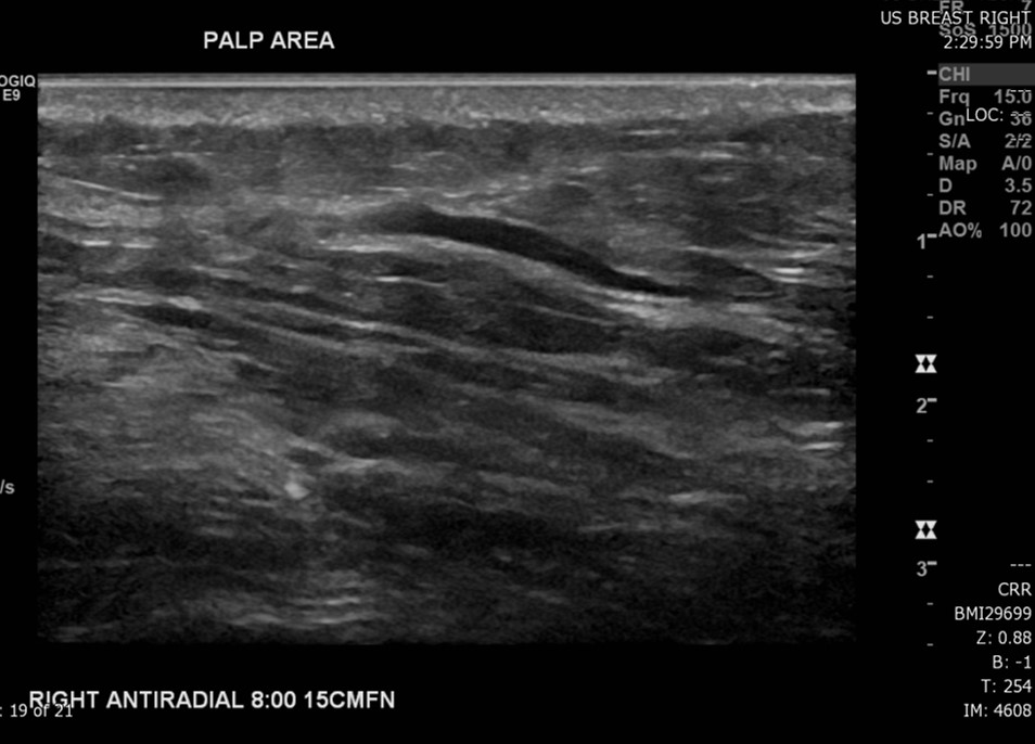 <p>Superficial Vein With an Area&nbsp;of Intraluminal Thrombus, Ultrasound